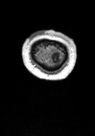 CNS cryptococcosis (Radiopaedia 70895-81108 Coronal T1 C+ 191).jpg