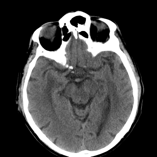 File:CNS lymphoma (Radiopaedia 36983-38639 Axial non-contrast 17).png