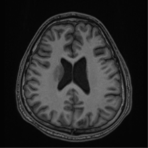 CNS vasculitis (Radiopaedia 55715-62263 Axial T1 54).png