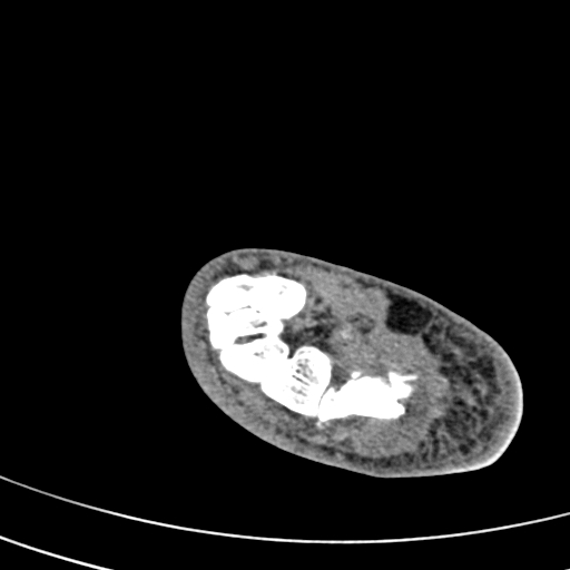 File:Calcaneal fracture - Sanders type 4 (Radiopaedia 90179-107370 Axial non-contrast 28).jpg