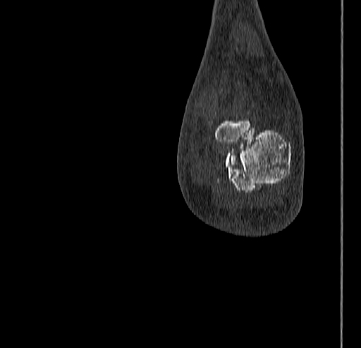 Calcaneal fracture - Sanders type 4 (Radiopaedia 90179-107370 Coronal bone window 79).jpg
