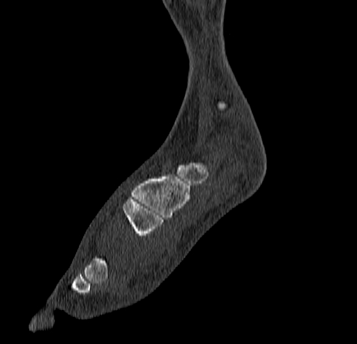 Calcaneal fracture - Sanders type 4 (Radiopaedia 90179-107370 Sagittal bone window 28).jpg