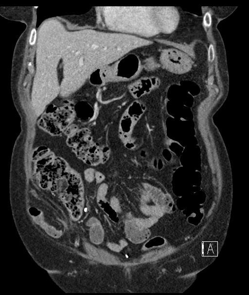 Calcified adrenal glands and Spigelian hernia (Radiopaedia 49741-54988 B 30).jpg