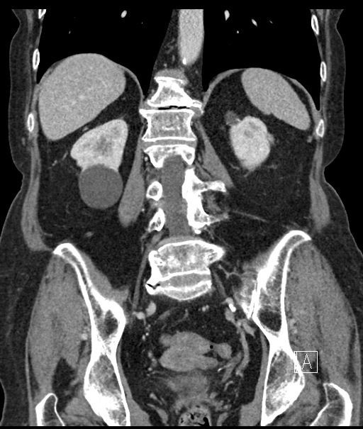 Calcified adrenal glands and Spigelian hernia (Radiopaedia 49741-54988 B 79).jpg