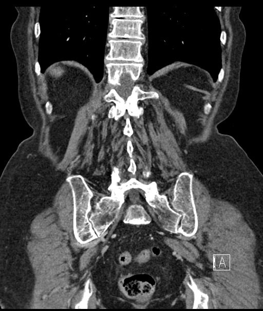 Calcified adrenal glands and Spigelian hernia (Radiopaedia 49741-54988 B 92).jpg