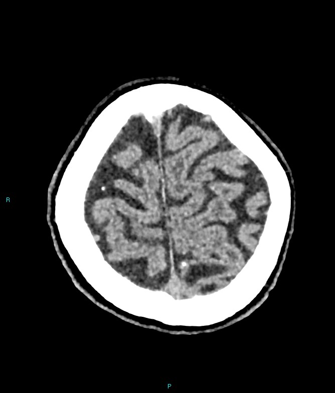 Calcified cerebral emboli from left ventricular thrombus (Radiopaedia 84420-99758 Axial non-contrast 16).jpg