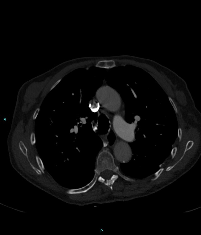 Calcified cerebral emboli from left ventricular thrombus (Radiopaedia 84420-99760 Axial bone window 30).jpg