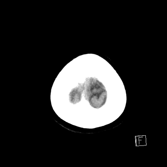 File:Calcified chronic subdural hematoma (Radiopaedia 77374-89492 Axial non-contrast 44).jpg