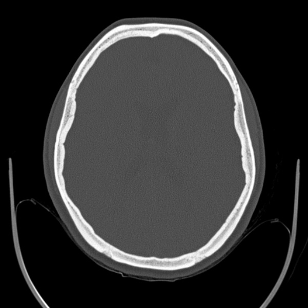 Calvarial osteoma (Radiopaedia 36520-38079 Axial bone window 64).jpg