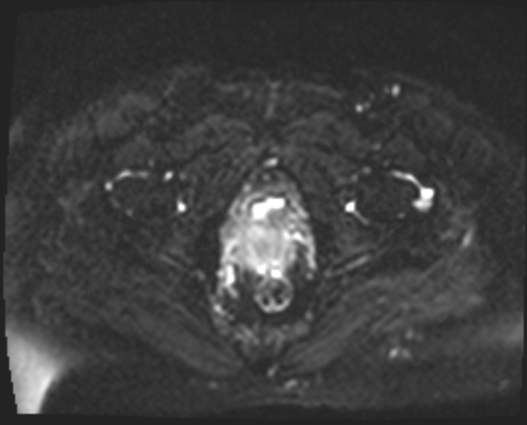 Cancer cervix - stage IIb (Radiopaedia 75411-86615 Axial DWI 7).jpg