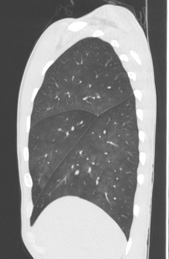 Cannabis-induced diffuse alveolar hemorrhage (Radiopaedia 89834-106946 Sagittal lung window 29).jpg