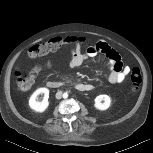 Cannonball metastases from endometrial cancer (Radiopaedia 42003-45031 E 38).png