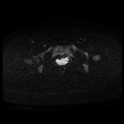 Carcinoma of the cervix (Radiopaedia 89018-105858 Axial DWI 49).jpg