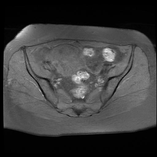 File:Carcinoma of the cervix (Radiopaedia 89018-105858 Axial T1 fat sat 5).jpg
