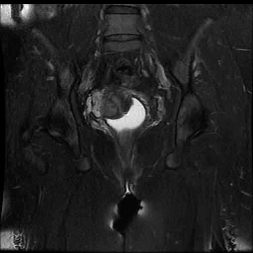 File:Carcinoma of the cervix (Radiopaedia 89018-105858 Coronal T2 fat sat 10).jpg