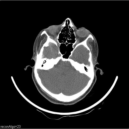 Carcinoma of the maxillary antrum (Radiopaedia 53805-59888 Axial non-contrast 69).jpg