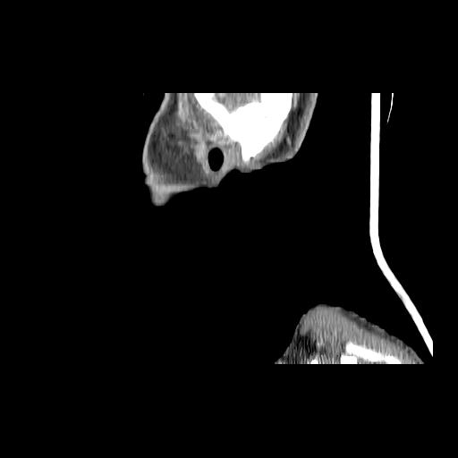 Carcinoma of the maxillary antrum (Radiopaedia 53805-59888 Sagittal C+ delayed 21).jpg