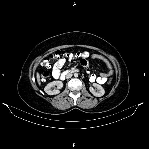 File:Carcinoma of uterine cervix (Radiopaedia 85861-101700 A 45).jpg