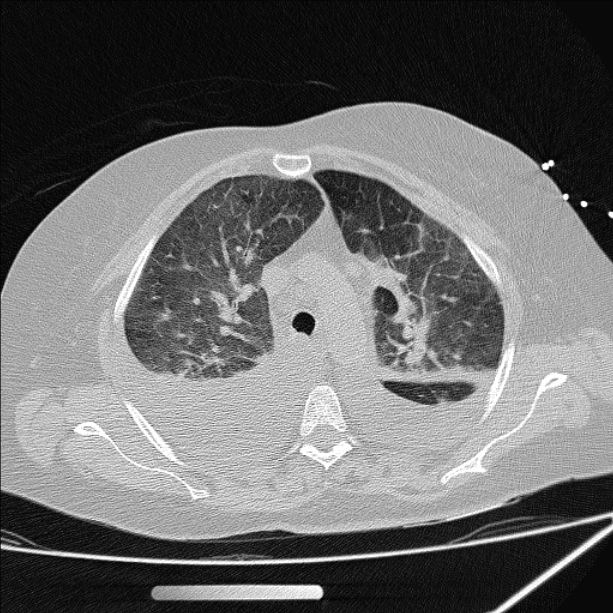 Cardiogenic pulmonary edema (Radiopaedia 29213-29609 Axial lung window 27).jpg