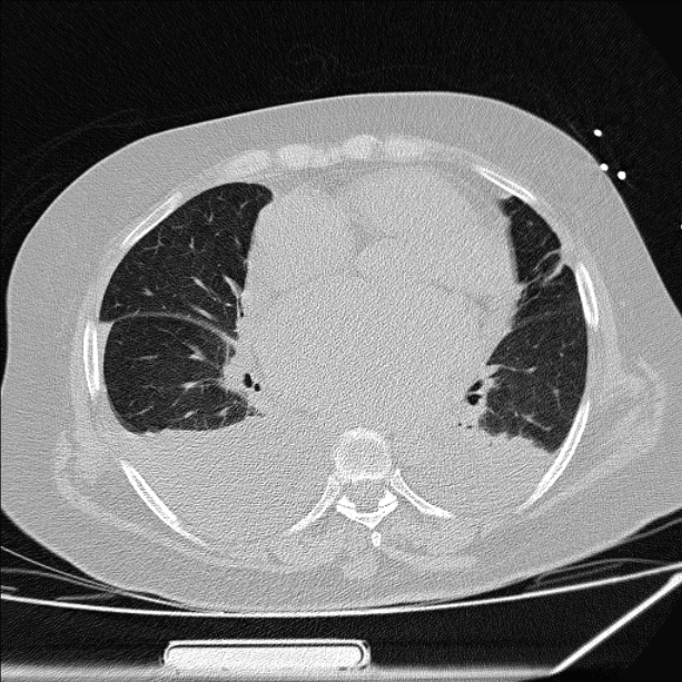 Cardiogenic pulmonary edema (Radiopaedia 29213-29609 Axial lung window 57).jpg