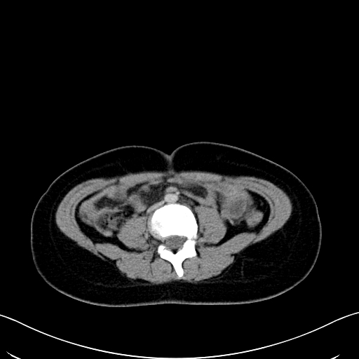 Caroli disease with medullary sponge kidney (Radiopaedia 82622-96804 C 43).jpg