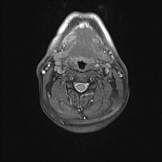 File:Carotid artery dissection (Radiopaedia 28441-28689 Axial T1 fat sat 23).jpg