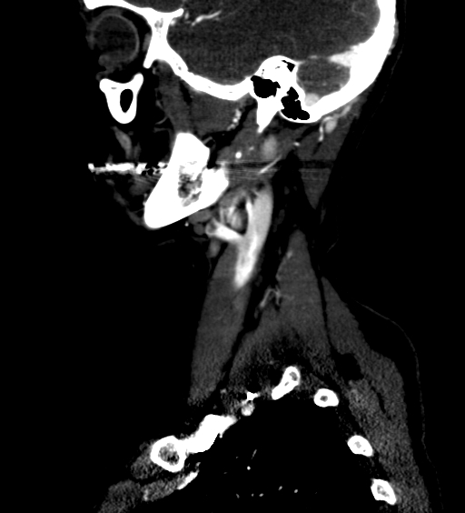 File:Carotid body tumor (Radiopaedia 39845-42300 D 1).jpg