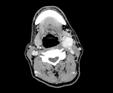 File:Carotid body tumor (Radiopaedia 61750-69757 Axial Post contrast 49).jpg