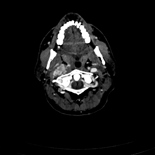 Carotid body tumor (Radiopaedia 83615-98727 D 39).jpg