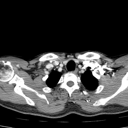 File:Carotid bulb pseudoaneurysm (Radiopaedia 57670-64616 A 70).jpg