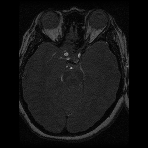 Cavernoma, DVA and right ICA aneurysm (Radiopaedia 33890-35072 E 51).png
