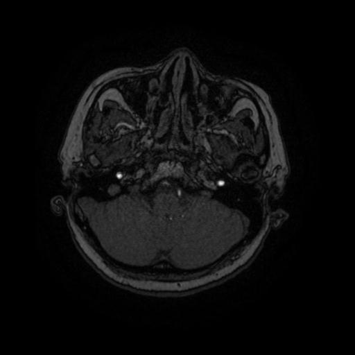 Cavernoma with developmental venous anomaly (Radiopaedia 22470-22507 MRA 81).jpg
