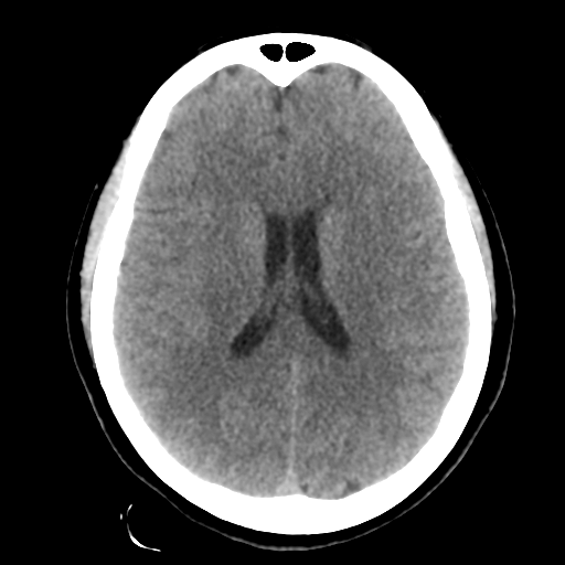 Cavernoma with hemorrhage (Radiopaedia 70755-80931 Axial non-contrast 32).png