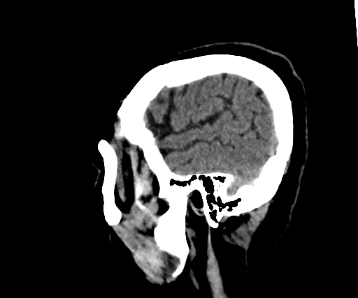 Cavernous hemangioma of the cerebellar falx (Radiopaedia 73025-83723 B 51).jpg