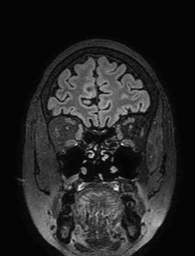Cavernous hemangioma of the cerebellar falx (Radiopaedia 73025-83724 Coronal FLAIR 58).jpg