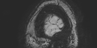 File:Cavernous hemangioma of the cerebellar falx (Radiopaedia 73025-83724 Sagittal BOLD 197).jpg