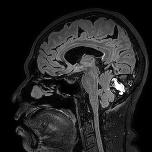 File:Cavernous hemangioma of the cerebellar falx (Radiopaedia 73025-83724 Sagittal FLAIR 99).jpg