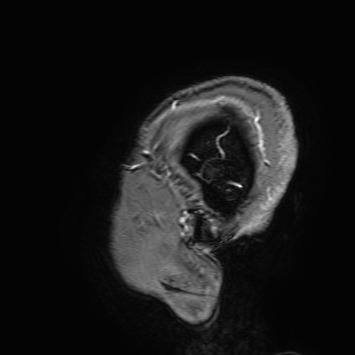 Cavernous hemangioma of the cerebellar falx (Radiopaedia 73025-83724 Sagittal T1 C+ 203).jpg