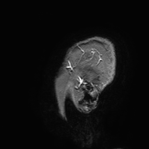 Cavernous hemangioma of the cerebellar falx (Radiopaedia 73025-83724 Sagittal T1 C+ 210).jpg