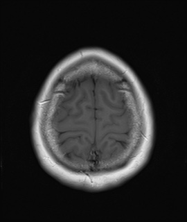 File:Cavernous sinus meningioma (Radiopaedia 63682-72367 Axial T1 20).jpg