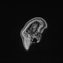 Cavernous sinus meningioma (Radiopaedia 63682-72367 Sagittal T1 C+ 164).jpg