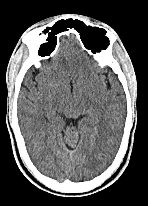 Cavum septum pellucidum and cavum vergae (Radiopaedia 77797-90060 Axial Brain Window 45).jpg