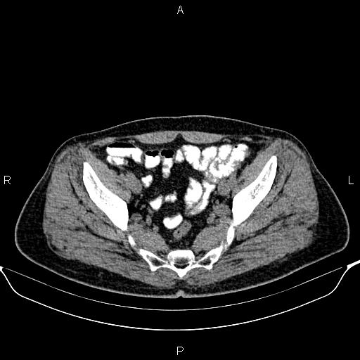 Cecal adenocarcinoma (Radiopaedia 85324-100916 Axial non-contrast 83).jpg