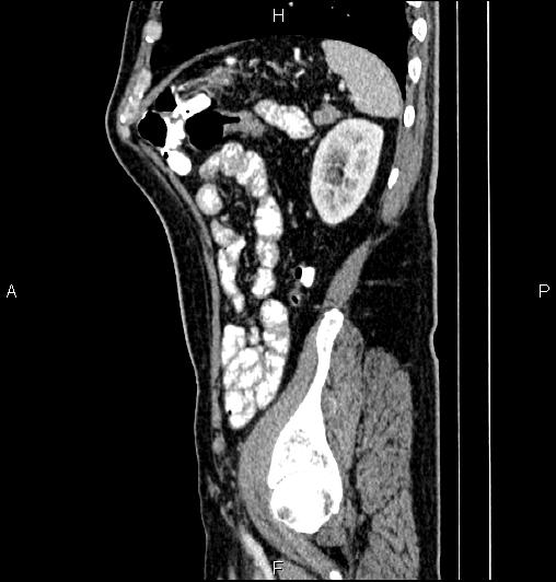 Cecal adenocarcinoma (Radiopaedia 85324-100916 E 74).jpg