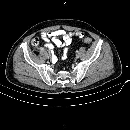 File:Cecal cancer with appendiceal mucocele (Radiopaedia 91080-108651 B 84).jpg