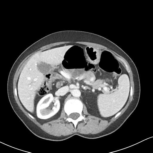 Cecal internal hernia through the foramen of Winslow (Radiopaedia 44820-48651 B 25).png