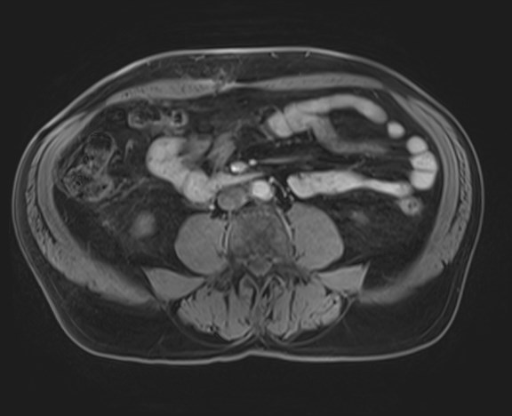 Cecal mass causing appendicitis (Radiopaedia 59207-66532 H 80).jpg