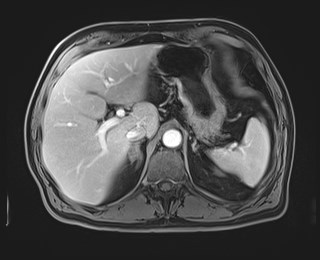 Cecal mass causing appendicitis (Radiopaedia 59207-66532 T1 C+ PV phase 38).jpg