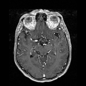 Central-variant posterior reversible encephalopathy syndrome (PRES) (Radiopaedia 43880-47358 Axial T1 C+ 66).jpg