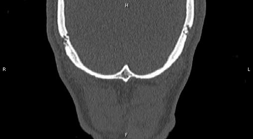 Central giant cell granuloma (Radiopaedia 83346-97761 Coronal bone window 51).jpg